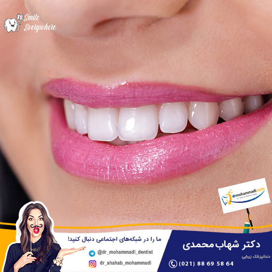 لمینت زیباتر است یا کامپوزیت؟ - کلینیک دندانپزشکی دکتر شهاب محمدی